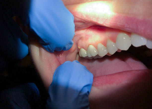 Best Emergency Denture Repair in Hardin, MT